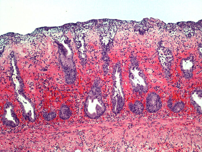 Laboklin: Akute hämorrhagische Proktitis bei einem Hund (Hämatoxylin-Eosin-Färbung, 100x). Bildquelle:Dr. Ulrike Schwittlick, Laboklin GmbH & Co. KG