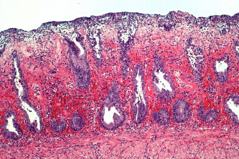 Laboklin: Akute hämorrhagische Proktitis bei einem Hund (Hämatoxylin-Eosin-Färbung, 100x). Bildquelle:Dr. Ulrike Schwittlick, Laboklin GmbH & Co. KG