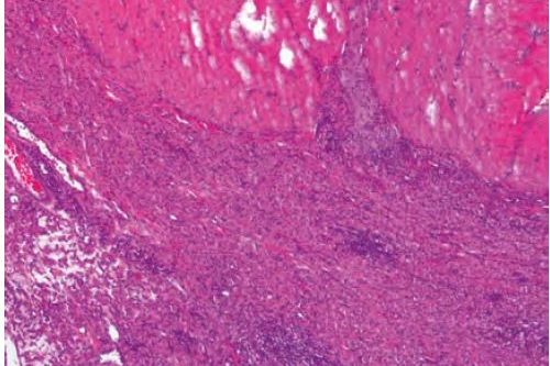 Laboklin: Hochgradige chronische histiozytäre bis gemischtzellige Kolitis beim Boxer