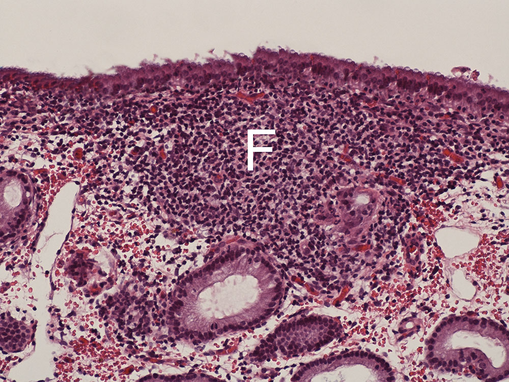 Laboklin: Chronische follikuläre (F) lymphoplas-mazelluläre Endometritis ohne Exsudatbildung (HE-Färbung, 200x)