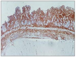 Laboklin: Immunhistologisches Bild eines T-Zelllymphoms, CD3-Immunhistologie, 40x Vergrößerung.