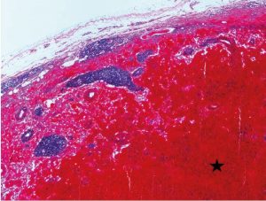Laboklin: Histologisches Bild eines Lymphknotens mit ausgeprägtem Verlust der organtypischen lymphatischen Strukturen mit hochgradigen Blutungen (Stern), (HE), 4x