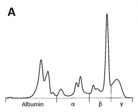 Laboklin: Kurve einer Serumproteinelektrophorese mit monoklonalem Peak in der Beta-Fraktion. Dieses Pferd zeigte eine hochgradige Leukozytose, darunter zahlreiche atypische Lymphozyten im peripheren Blut