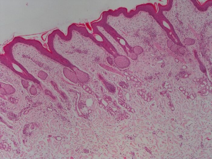 Laboklin: Histologisches Präparat (HE-Färbung, 40fache Vergrößerung): Haut mit telogenen Haarfollikeln und gemischtzelliger Entzündung