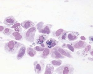 Laboklin: Feinnadelaspiration, spindelförmige bis polymorphe Zellen mit schwarzen Granula im Zytoplasma, Melanophorom (Pappenheim-Färbung, 500x)