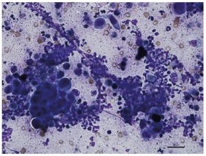 Laboklin: Zytologisches Bild eines Prostatakarzinoms mit Prostatitis: zahlreiche, teils degenerierte neutrophile Granulozyten und Verbände von pleomorphen Prostataepithelzellen mit großen, unterschiedlich geformten Zellkernen (Haema-Schnellfärbung, bar = 25 μm)