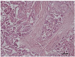 Laboklin: Histologisches Bild eines hochaggressiven, infiltrativ wachsenden tubulopapilliformen Prostatakarzinoms (Gleason Pattern 3, Score Summe 8, bar = 100 μm)