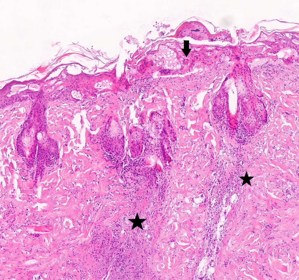 Laboklin: Hautbiopsie mit dermaler ausgeprägter Nekrose (Stern), epidermaler Hyperplasie mit Ödematisierung und intrakornealen intrazytoplasmatischen Einschlüssen. 4x HE