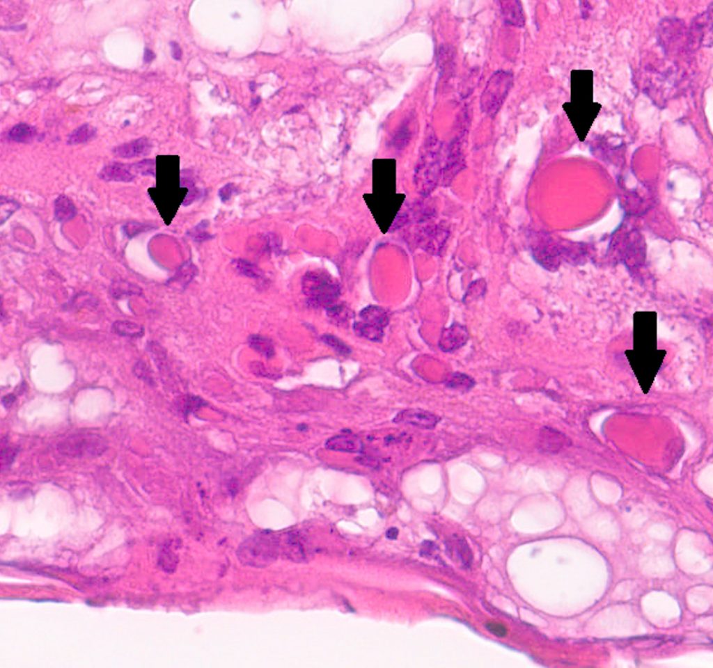 Laboklin: Hautbiopsie. Nachweis von Keratinozyten mit intranukleären eosinophilen Einschlusskörperchen (Pfeile). 40x HE.