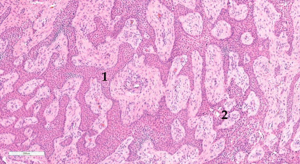 Laboklin: stologisches Bild eines CAA, Hund.  1) Vorherrschend odontogenes Epithel. 2) Frühe intraepitheliale Zystenbildung. HE-Färbung, 10x Obj.
