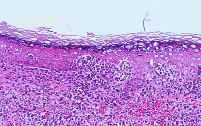 Laboklin: Meerschweinchen: Haut, epitheliotropes T-Zell-Lymphom, Hämatoxylin-Eosin (HE) -Färbung
