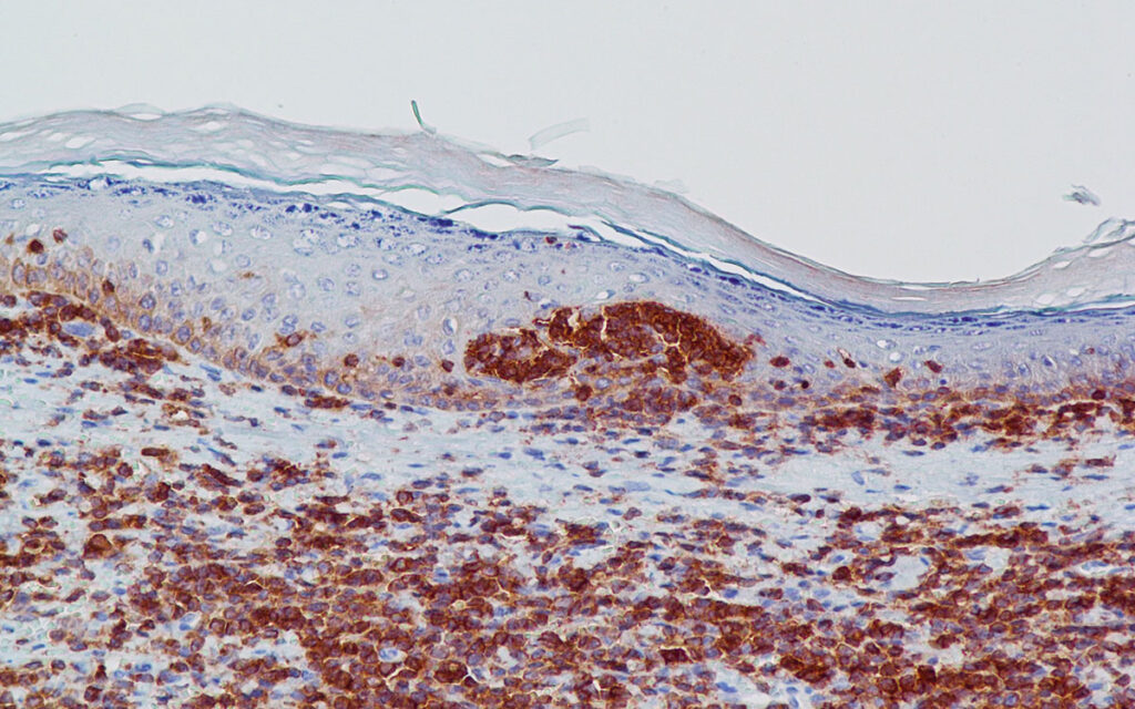 Laboklin: Meerschweinchen: Haut, epitheliotropes T-Zell-Lymphom – Immunhistologie mit positiver Reaktion des CD3- (T-Zell-Lymphozyten-) Markers