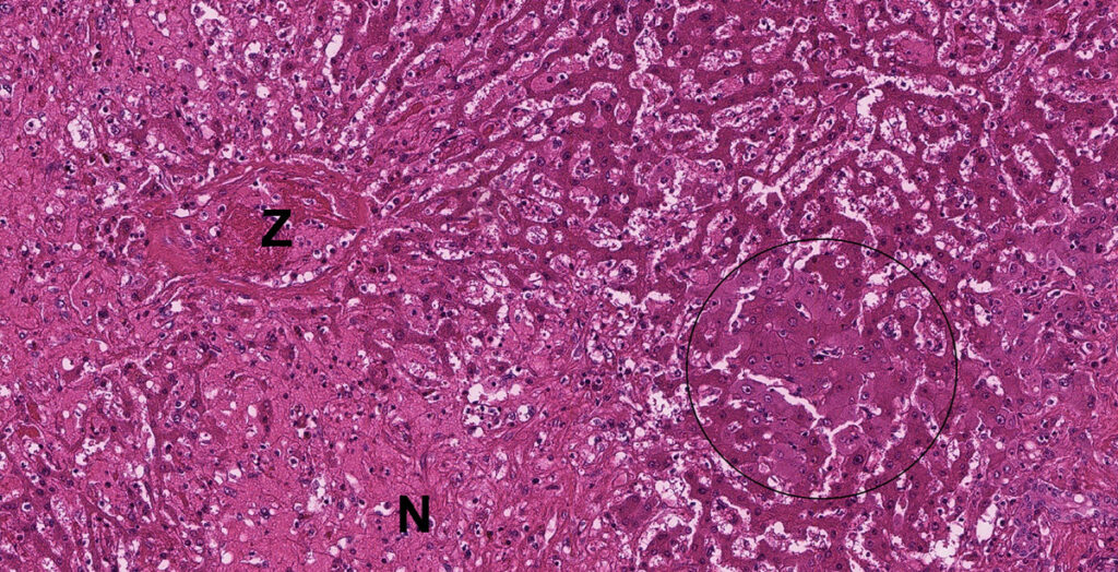 Laboklin: Pathohistologisches Präparat einer Leberbiopsie: hepa- tische Nekrose bei einem Pferd Z = Zentralvene, N = Nekrose, Kreis = hochgradig geschwollene Hepatozyten