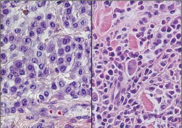 Laboklin: Histologisches Erscheinungsbild eines Mastzelltumors Grad I (links) und eines Mastzelltumors Grad III in der HE-Färbung