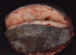 Laboklin: Exzisat eines Spindelzelltumors
