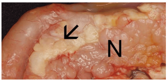 Laboklin: Akute Pankreasnekrose (Pfeil) neben makroskopisch normalem Pankreasgewebe (N) bei einer Katze.