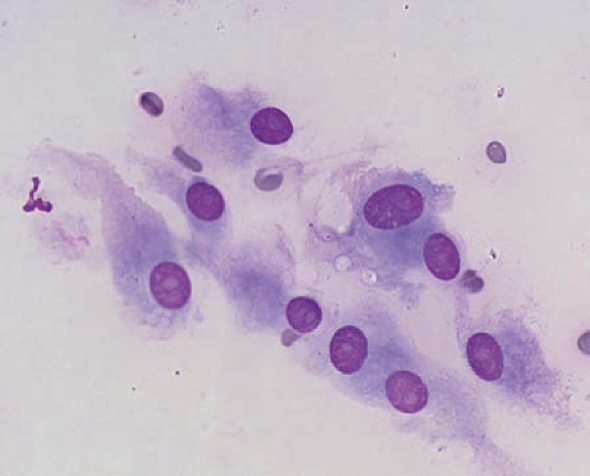 Laboklin: Zytologie eines gut bis mäßig differenzierten Sarkomes