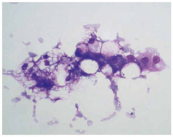 Laboklin: zytologisches Bild einer fettigen Leberdegeneration