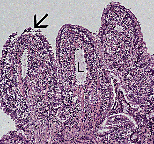 Laboklin: Histologische Läsionen bei einer LPE (Pfeil auf Epithelläsionen, L = milde Lymphangiektasien), HE 100x