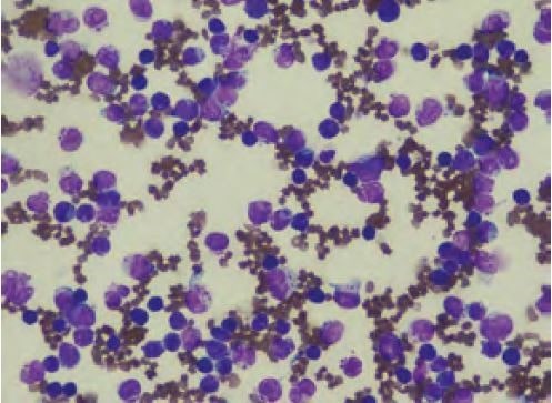 Laboklin: Blutausstrich einer Katze, chronische lymphatische Leukämie mit Ursprung in den zytotoxischen Lymphozyten (T-Zellen), 500fache Vergrößerung, Diff-Quick-Färbung
