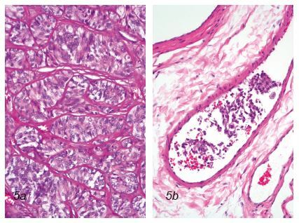 Laboklin: Sertolizelltumor mit palisadenartig angeordneten Tumorzellen (Abb 5a) und Gefäßeinbrüchen (Abb. 5b)