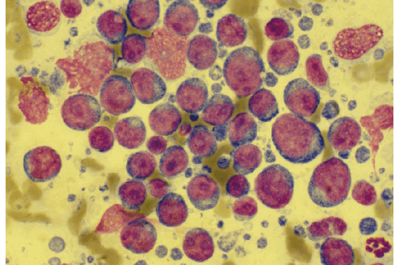 Lymphknoten; die Zellen liegen im Monolayer, die Färbequalität ist gut, ein Lymphom kann diagnostiziert werden