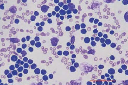 Laboklin: Blutausstrich eines Hundes, nicht weiter differenzierte lymphatische Leukämie, 500fache Vergrößerung, Diff-Quick-Färbung