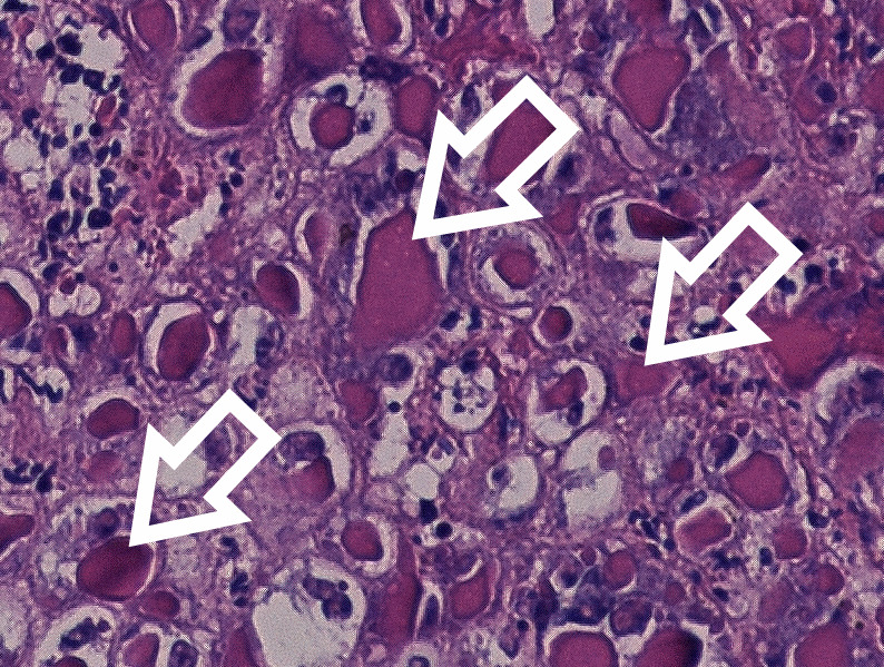Laboklin: Histologie der Haut mit Pockenvirus-Infektion. Es zeigt sich eine hochgradige ballonierende Degeneration der Epithelzellen mit charakteristischen zytoplasmatischen Bollinger-Einschlusskörperchen (Pfeile).