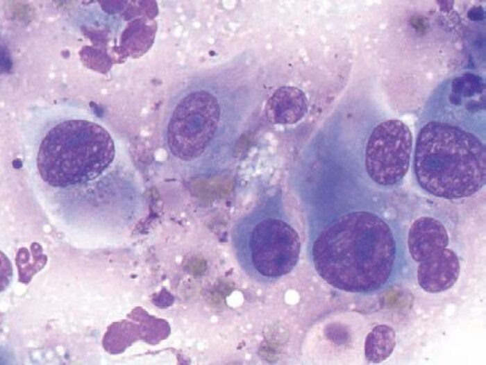 Laboklin: Zytologie: Übergangszellkarzinom, Hund, 13 Jahre, mk