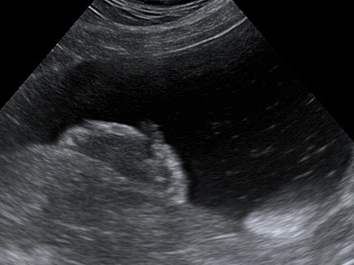 Ultraschallbild eines Harnblasenkarzinoms 