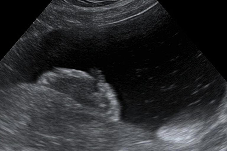 Ultraschallbild eines Harnblasenkarzinoms