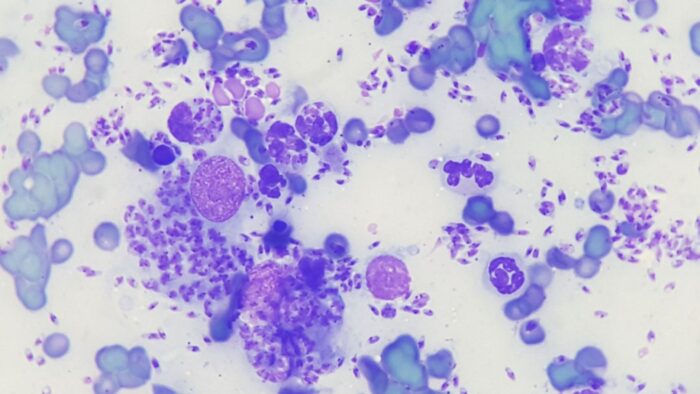 Pyogranulomatöse Entzündung mit Nachweis von Leishmanien 