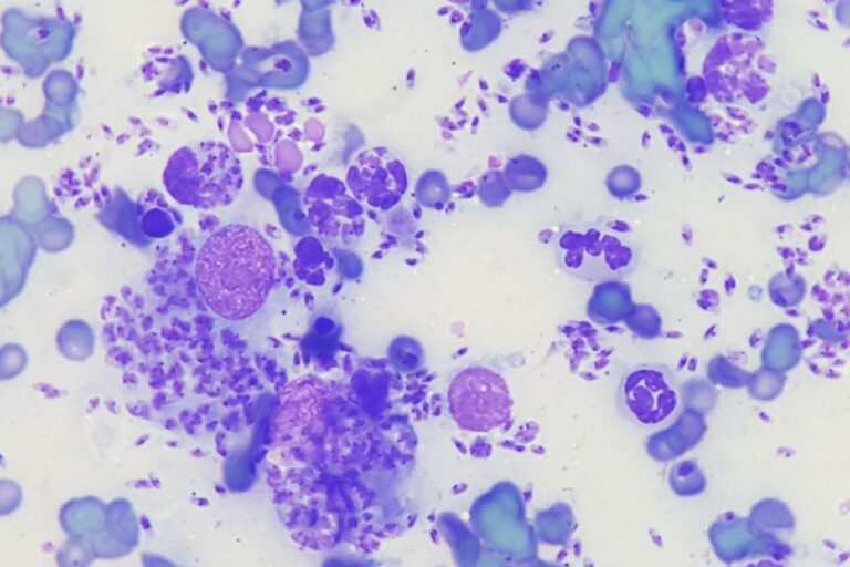 Pyogranulomatöse Entzündung mit Nachweis von Leishmanien