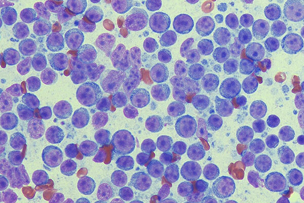 lymphom 50x diffquick
