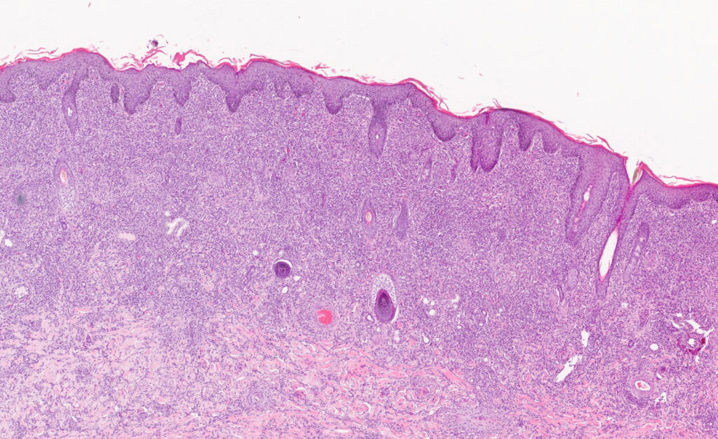 histologisches Präparat einer diffusen granulomatösen Entzündung, HE Färbung, 20fache Vergrößerung