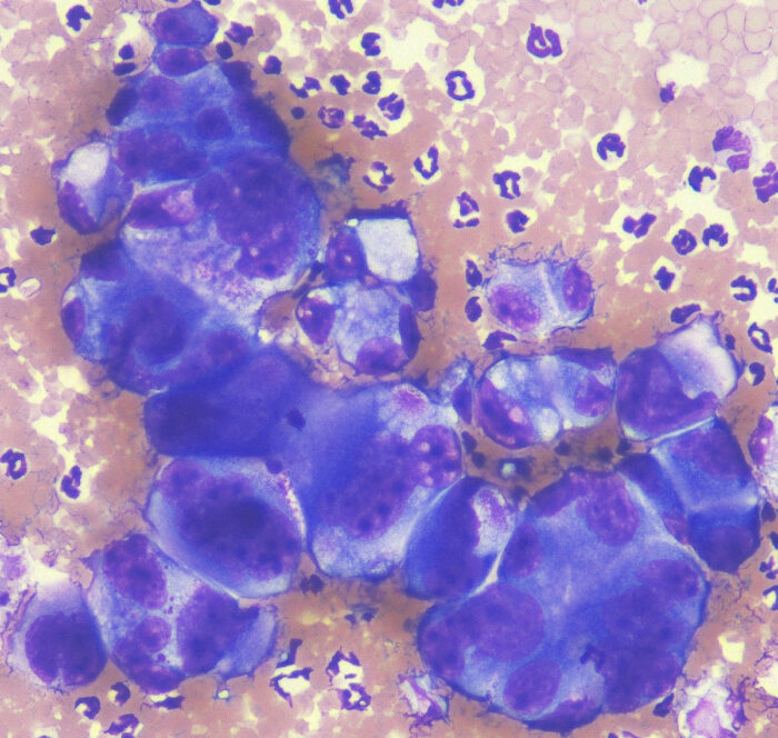 pleomorphe Zellen eines Karzinoms