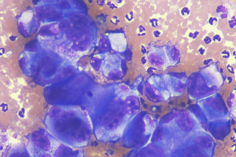 pleomorphe Zellen eines Karzinoms