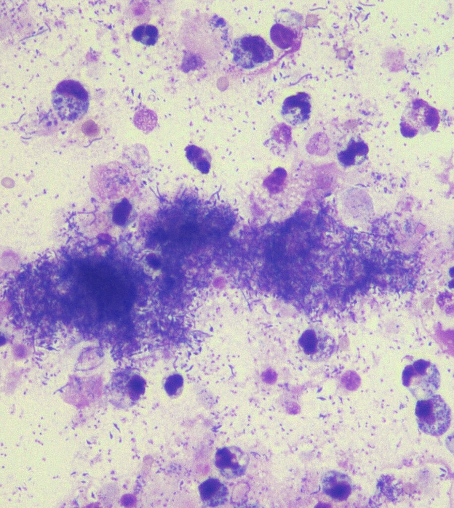 septischer Erguss; Diff-Quick-Färbung, 400fache Vergrößerung