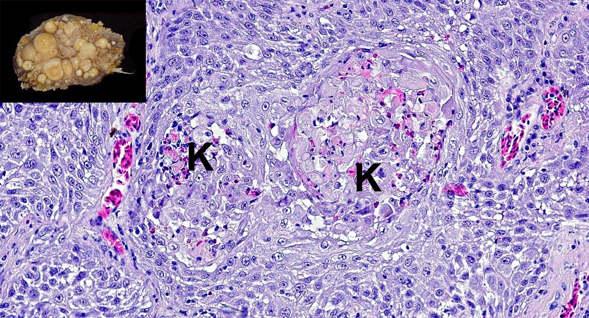 histologie eines plattenepithelkarzinoms in der bürzeldrüse eines wellensittichs (inlay)